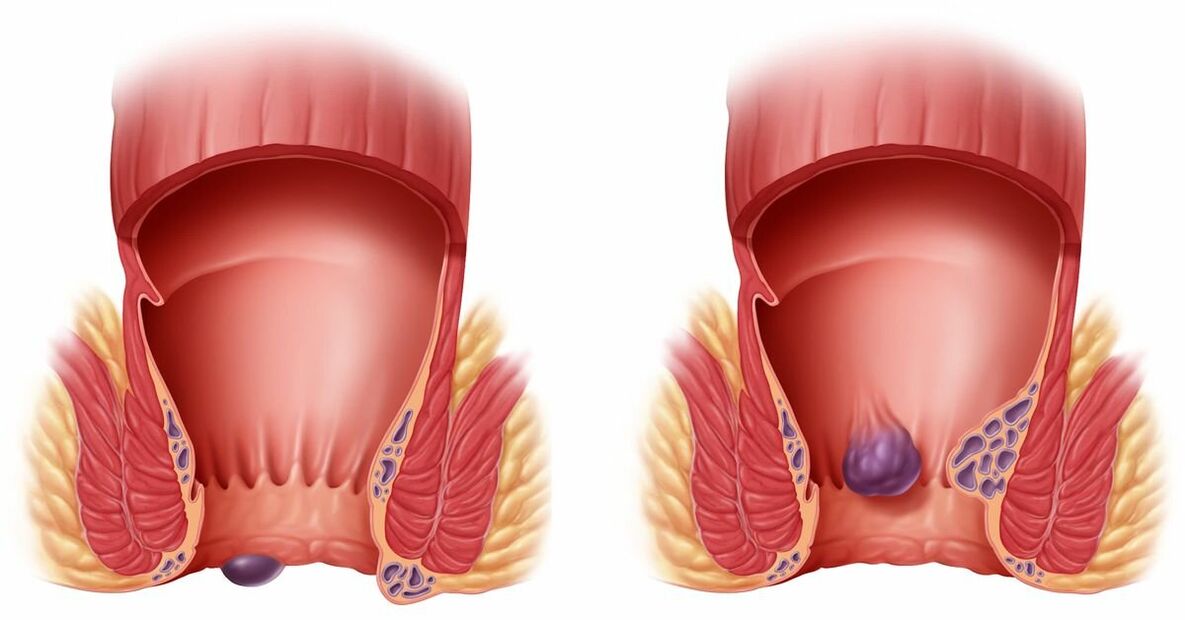 Gelarex hilft bei internen und externen Hämorrhoiden