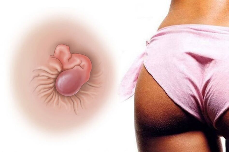Natürliche Creme heilt Hämorrhoiden in einem Kurs