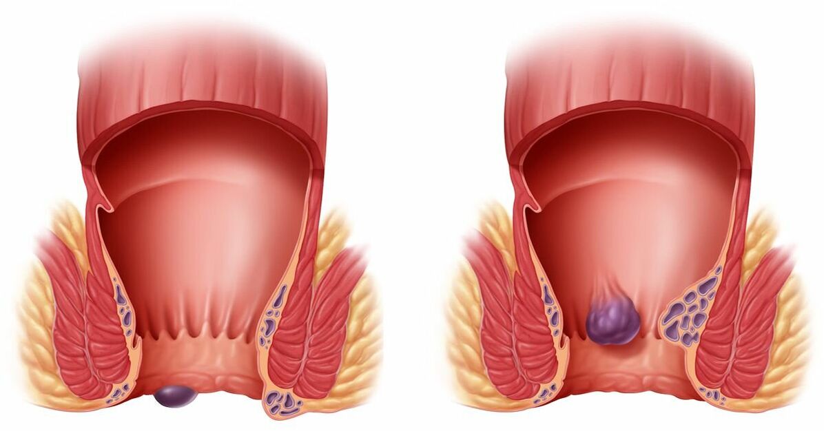ZXCVBNMQWORT hilft bei internen und äußeren Hämorrhoiden